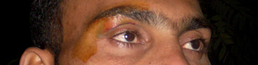 स्ट्रिंगर की आंख पर लगे चोट के निशान