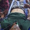 Patient lying on a hospital bed wearing a green shirt with an oxygen mask and medical tubes, surrounded by staff attending to him.