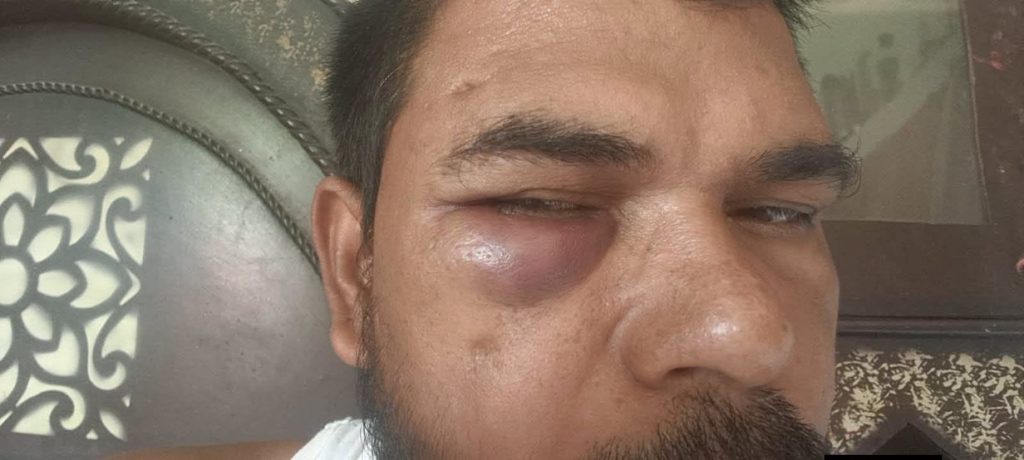 Close-up of a man with a bruised, swollen left eye and a trimmed beard, looking to the side.