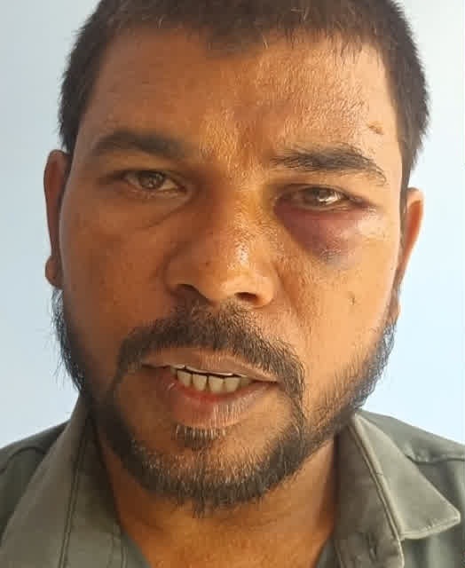 Close-up of a man with a bruised left eye and facial wounds at the cheek and mouth edge.