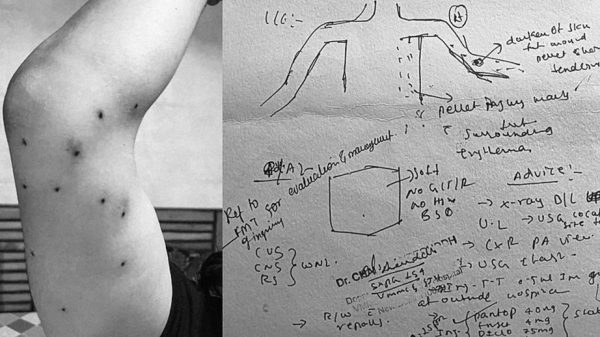 Arm with many small dark marks next to a whiteboard filled with hand-drawn diagrams and notes.