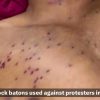 Close-up of a bruised chest with many small pellet wounds from police clashes in Delhi (news thumbnail).