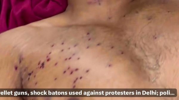 Close-up of a bruised chest with many small pellet wounds from police clashes in Delhi (news thumbnail).