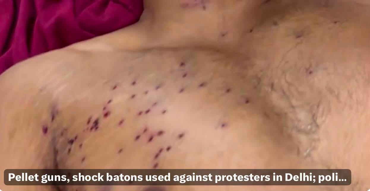 Close-up of a bruised chest with many small pellet wounds from police clashes in Delhi (news thumbnail).