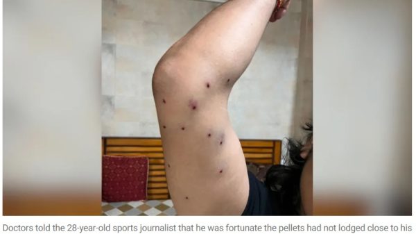 Raised arm showing multiple small pellet-entry wounds along the upper arm.