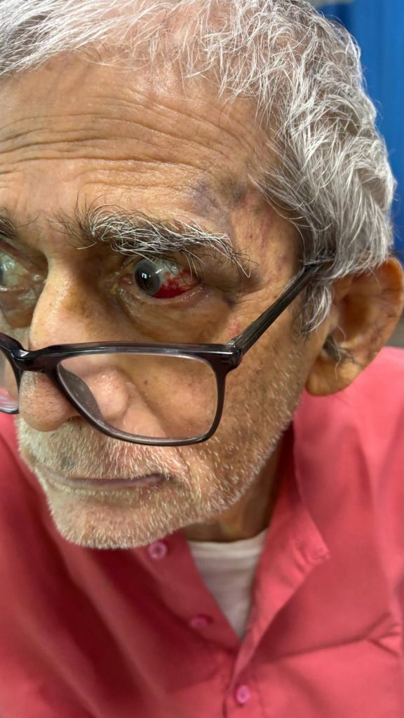 Close-up of an older man with gray hair and glasses, his left eye red and irritated.