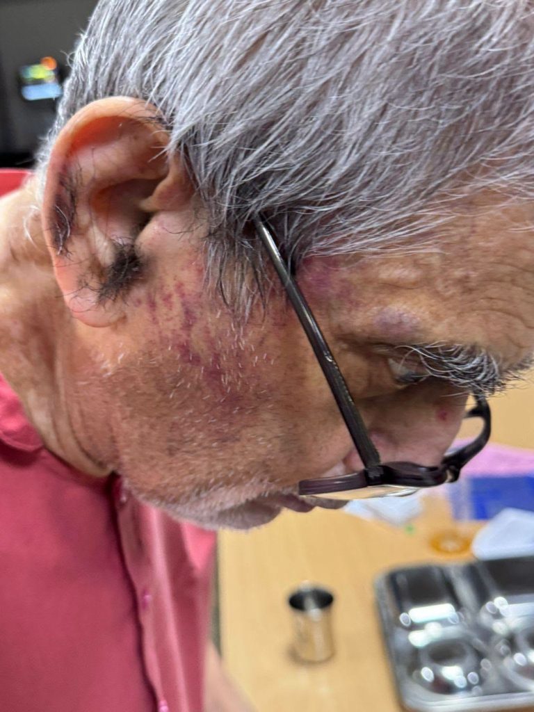 Close-up side view of an older man with gray hair and glasses resting on his nose, showing purple bruising or marks along the jawline and cheek in a clinical setting