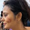 Side profile of a woman with a bruised, reddish facial injury on her left cheek in a purple top.