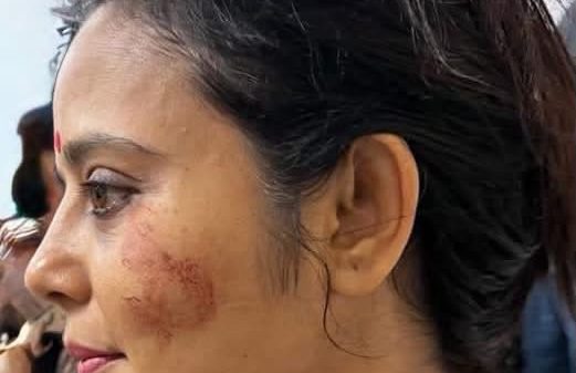 Side profile of a woman with a bruised, reddish facial injury on her left cheek in a purple top.