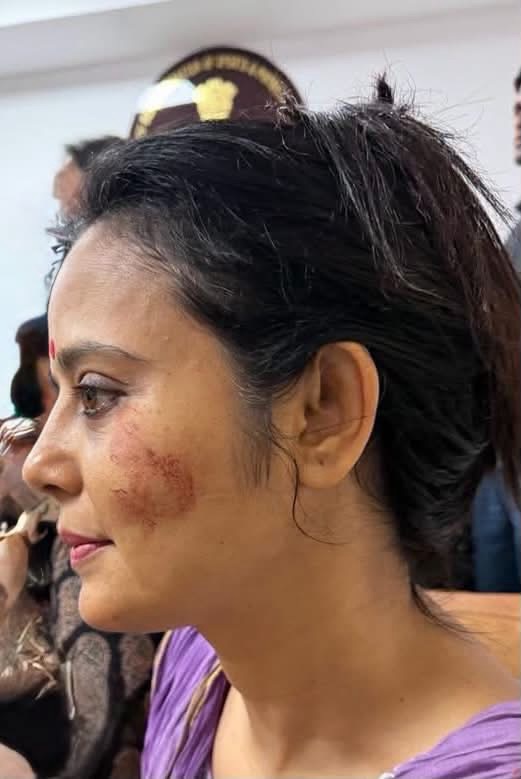 Side profile of a woman with a bruised, reddish facial injury on her left cheek in a purple top.